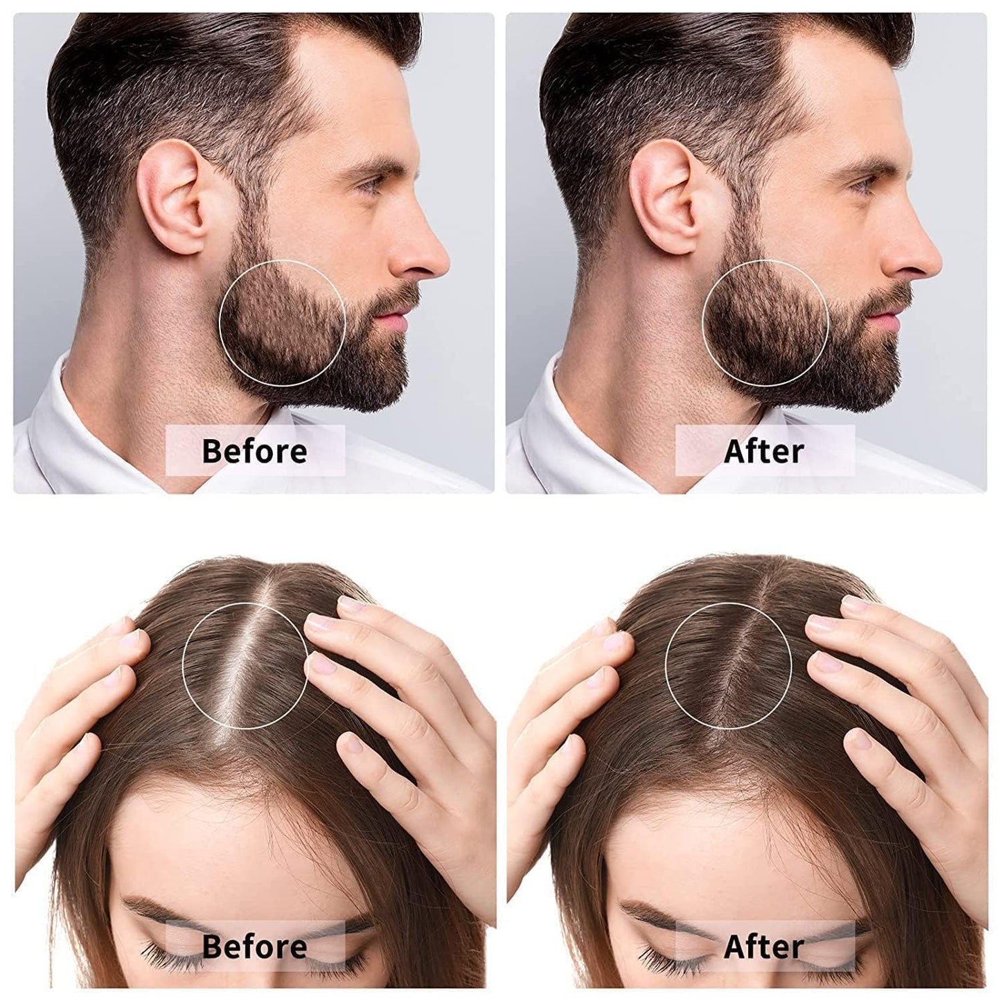 Derma roller