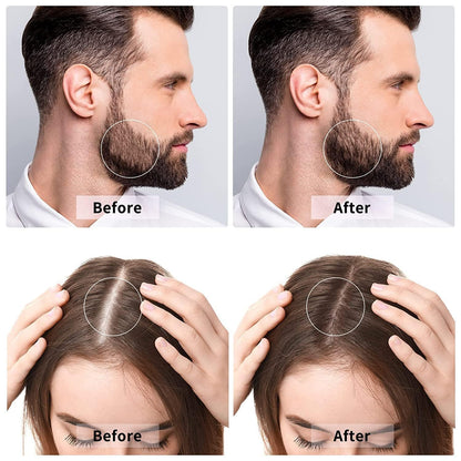 Derma roller
