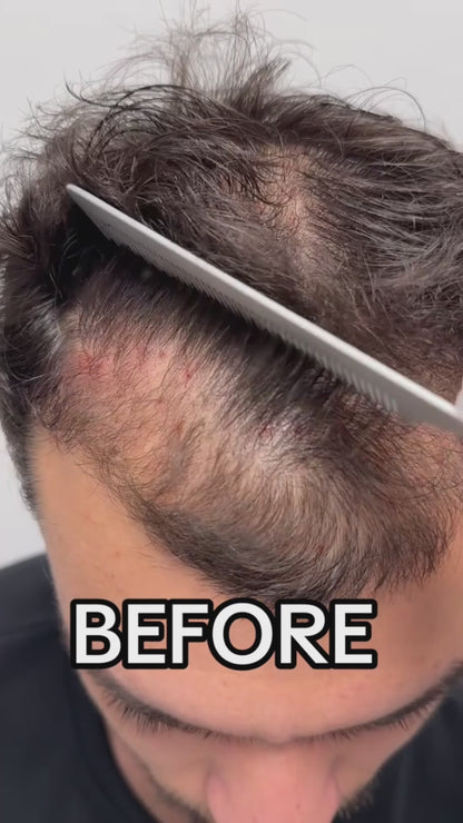 Derma roller